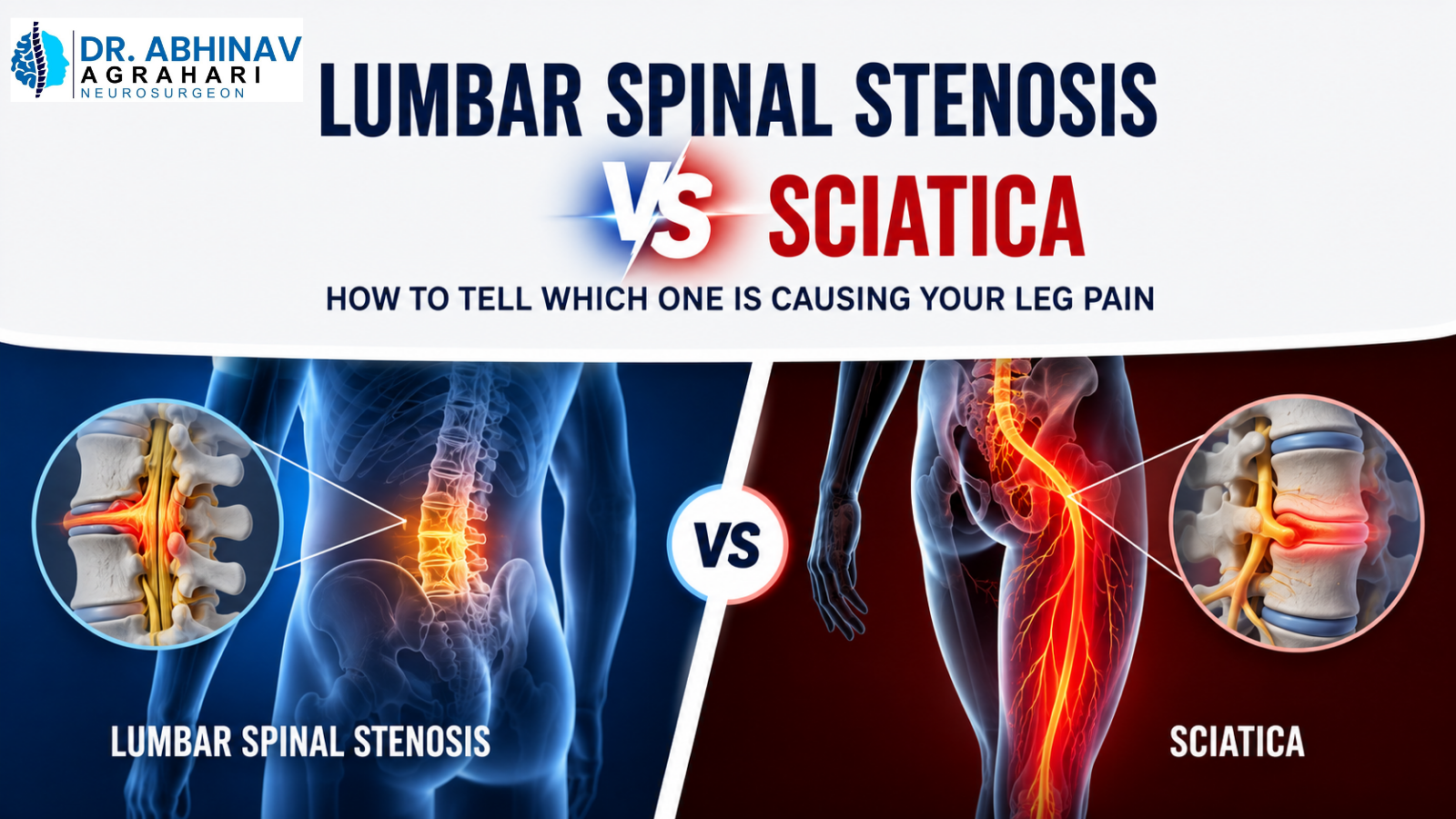 Lumbar Spinal Stenosis vs Sciatica: How to Tell Which One Is Causing Your Leg Pain